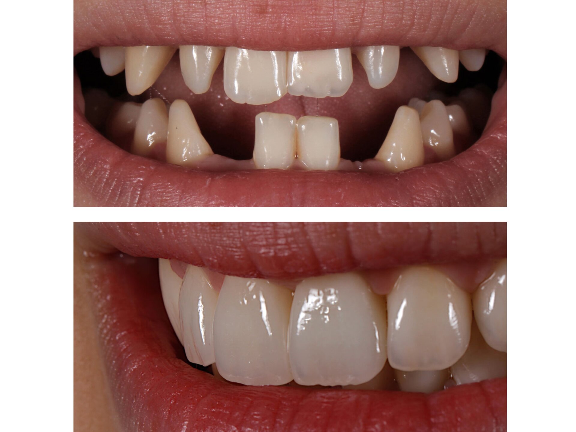 IPS e.max Press | Glass-ceramic restorations | Ivoclar US